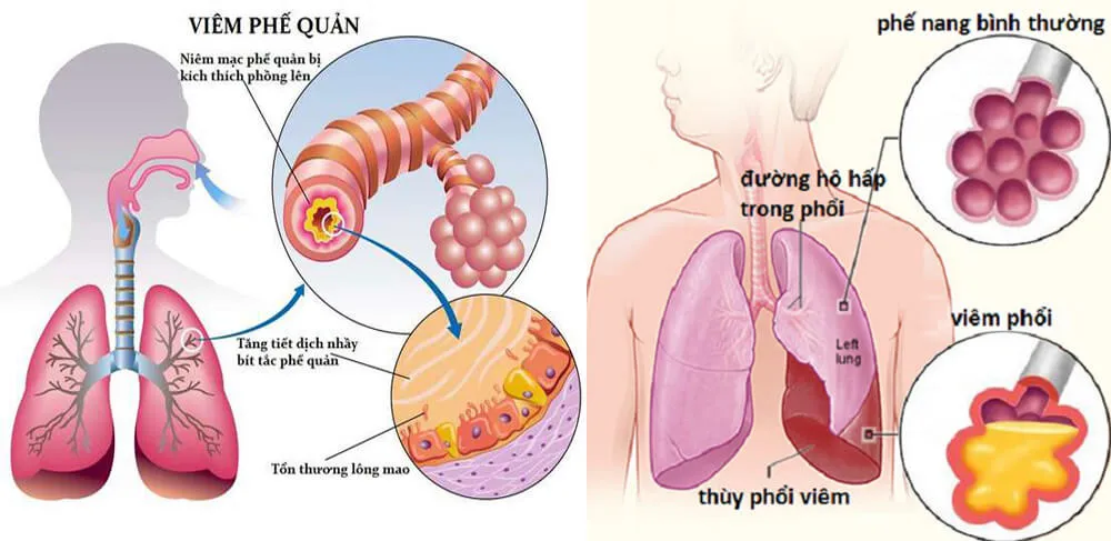  Làm sao để biết bị viêm phế quản? Tư vấn của chuyên gia